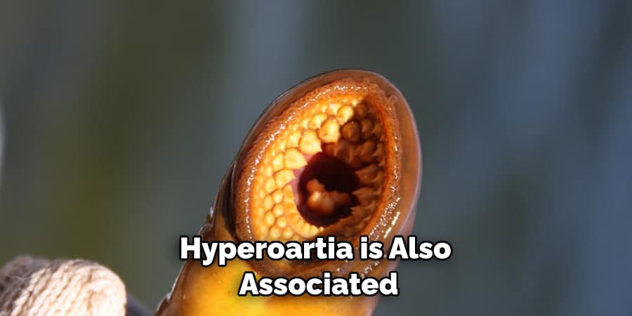 Hyperoartia is also associated